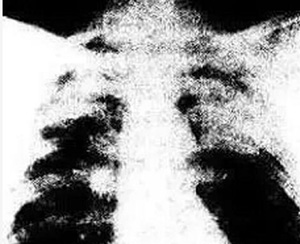 電焊工的職業(yè)病——塵肺病 電焊工的職業(yè)病——塵肺病